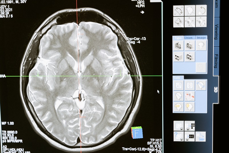 A scan of the human brain - to illustrate the odd fact about dying brain cells