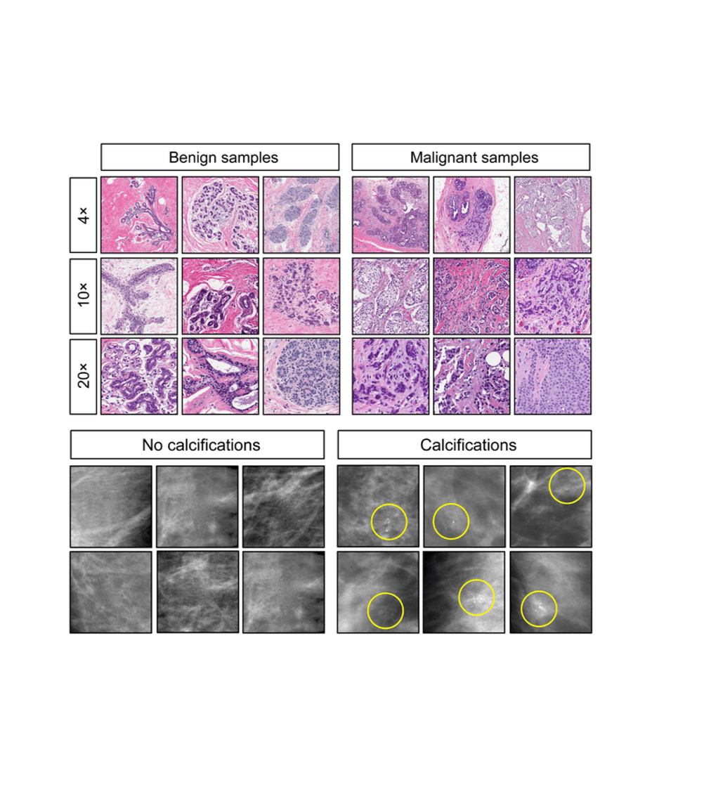 How To Do Reinforcement Learning in Real Life: Example datasets from the reinforcement learning experiment. Top Left: Benign samples; Top Right: Malignant samples; Bottom Left: No calcifications; Bottom Right: Calcifications.